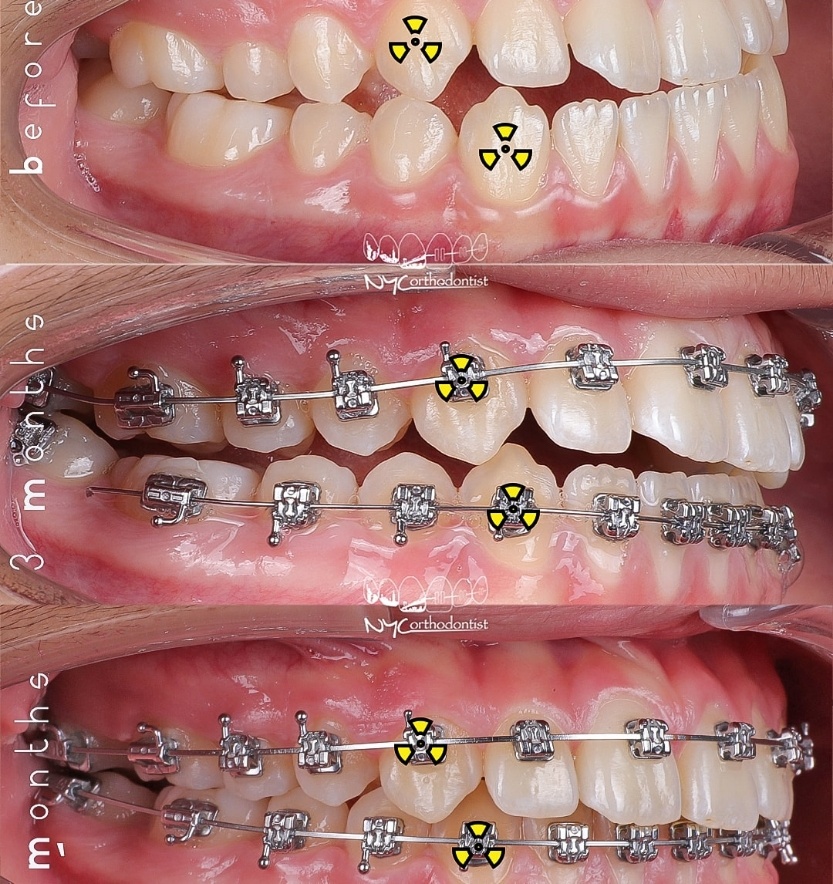 Side of smile before during and after underbite treatment