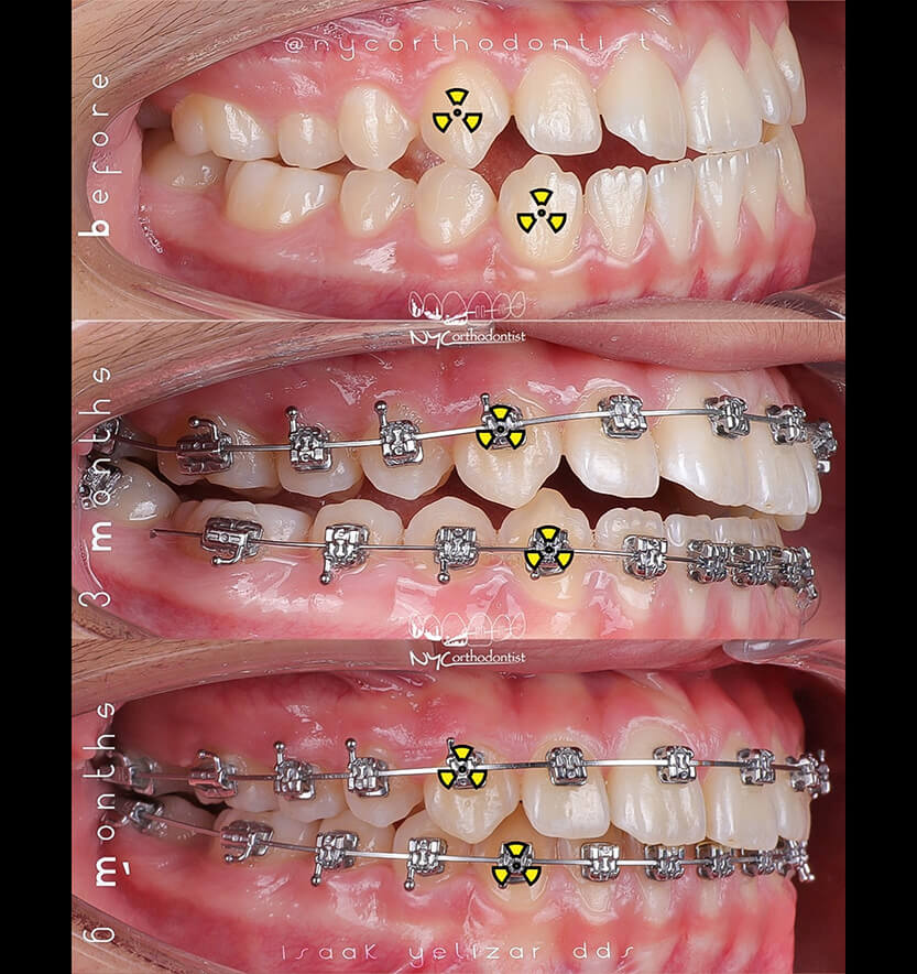 Side of smile before during and after underbite treatment