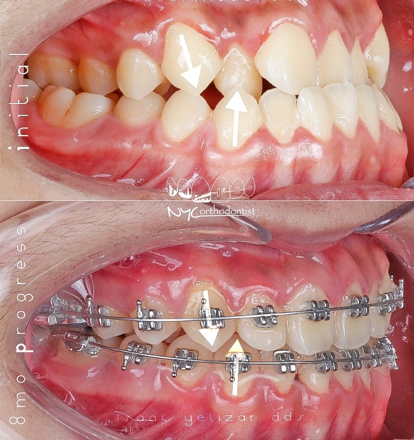 Side of smile before and after underbite treatment