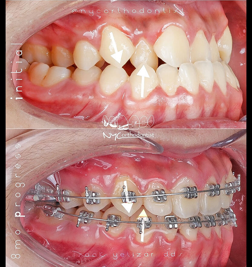 Side of smile before and after underbite treatment