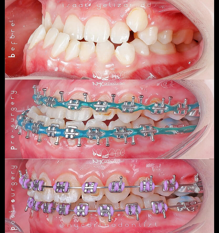 Side of patient's smile before during and after underbite treatment