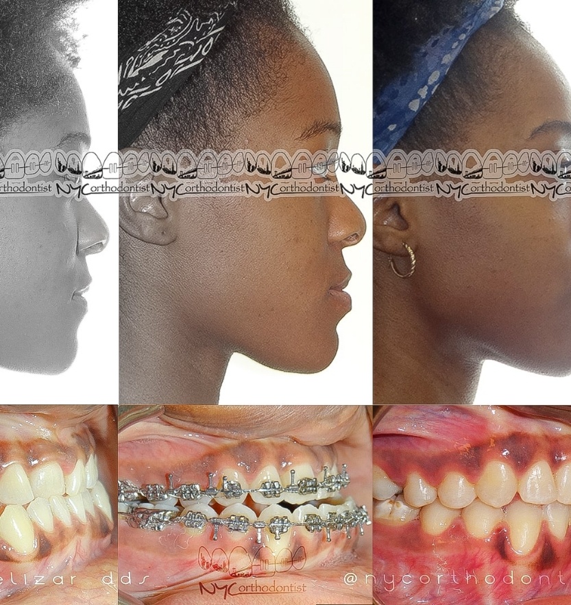 Patient's profile before during and after underbite treatment