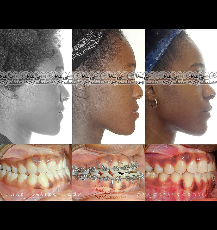 Patient's profile before during and after underbite treatment