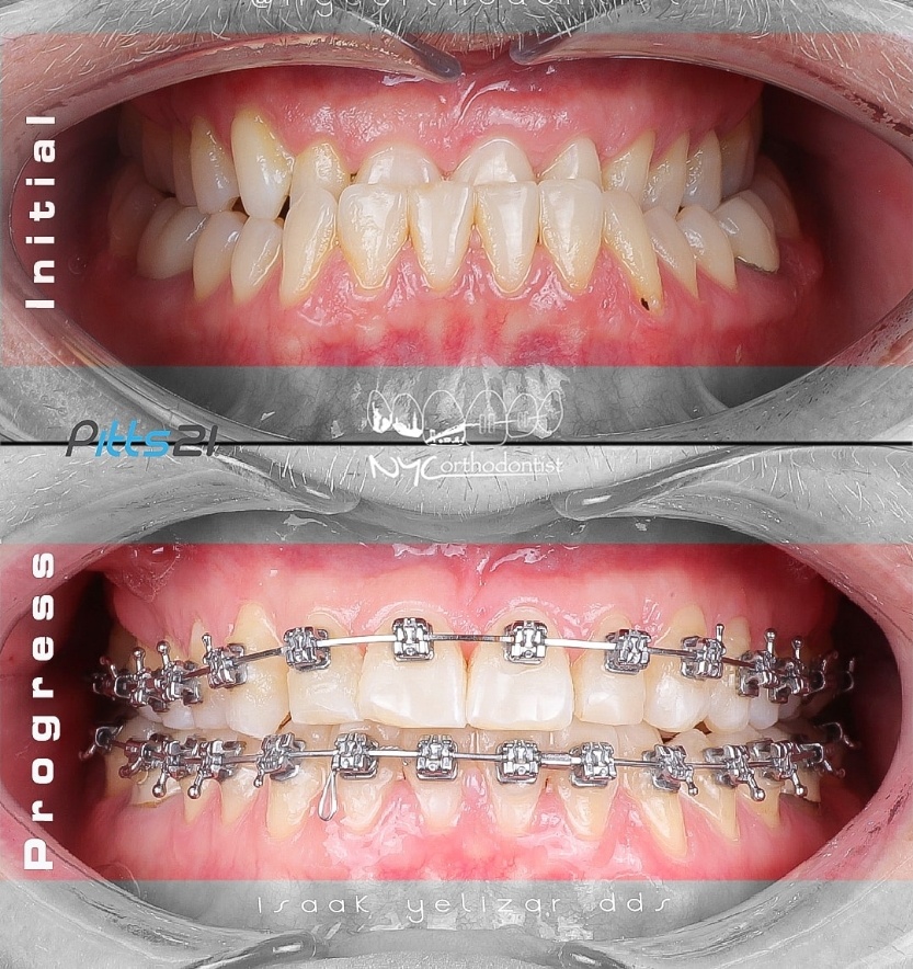 Front of smile before and during underbite treatment