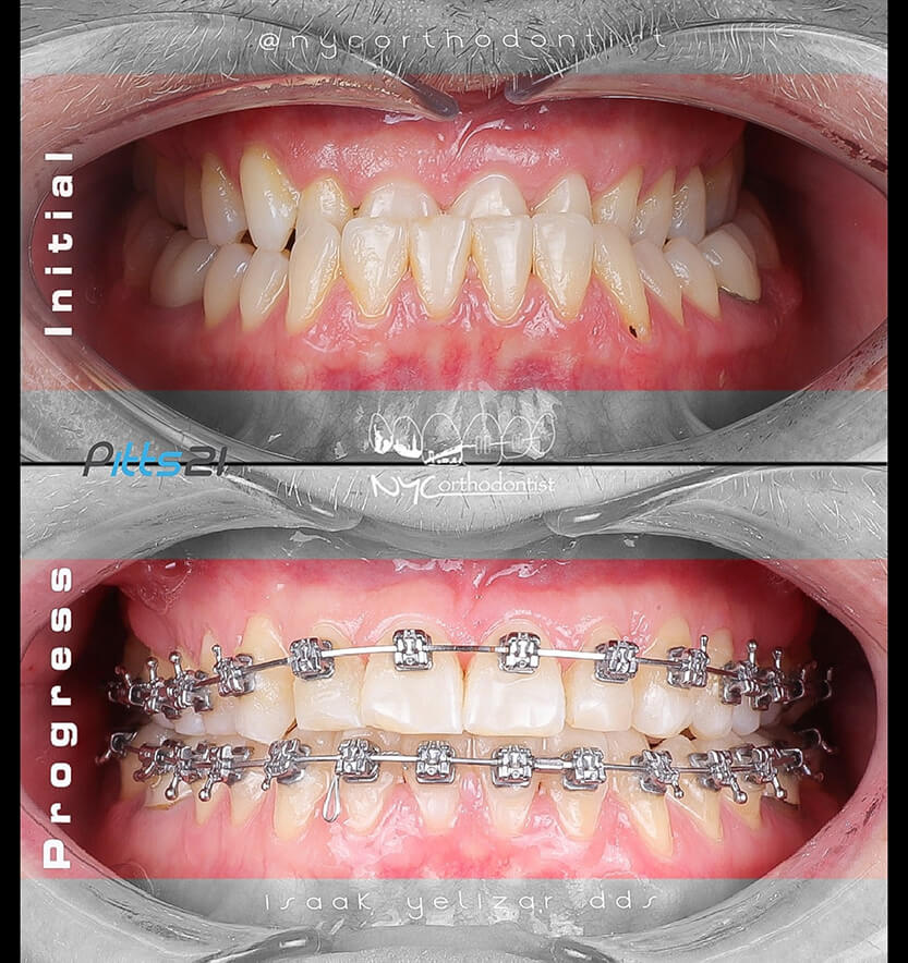 Front of smile before and during underbite treatment