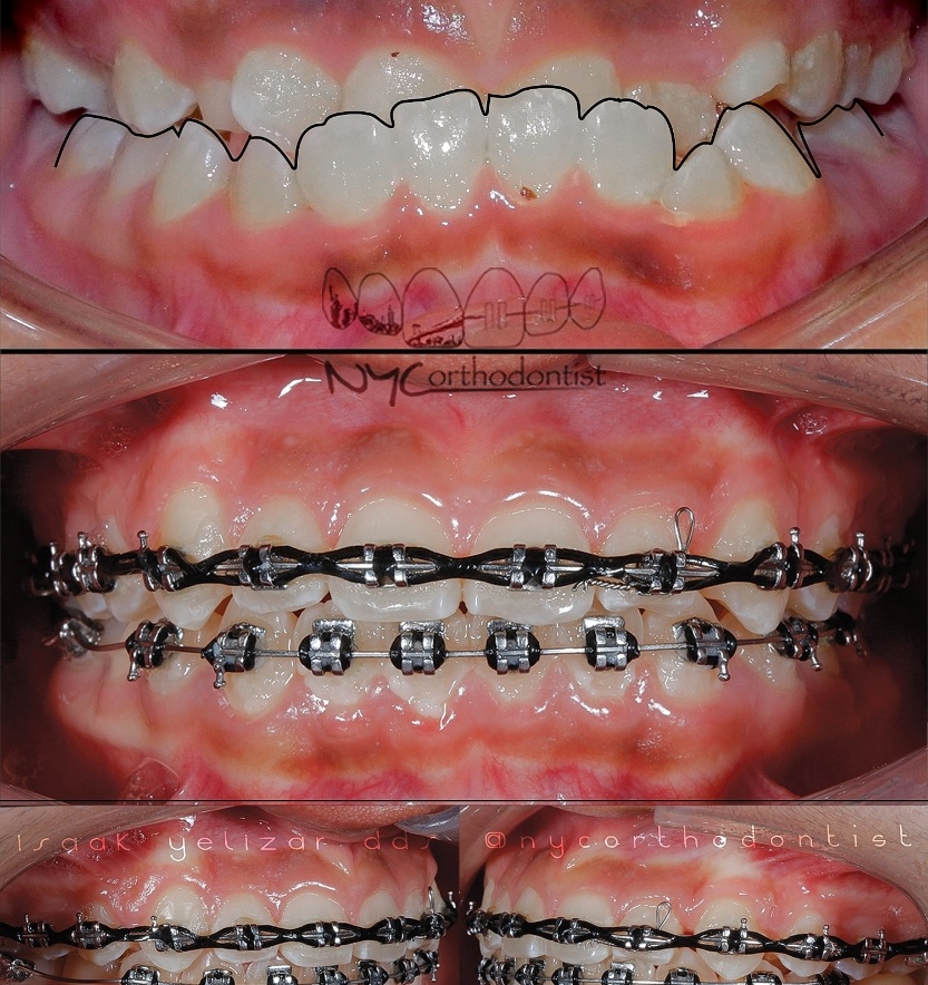Front and side of smile before and after treatment for underbite