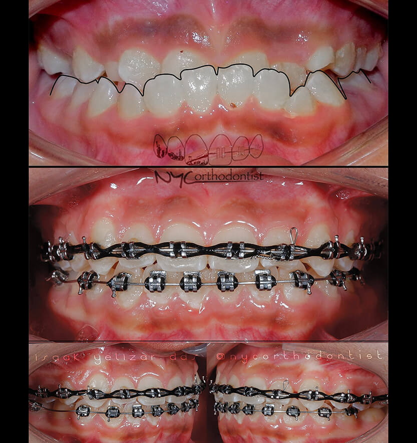 Front and side of smile before and after treatment for underbite