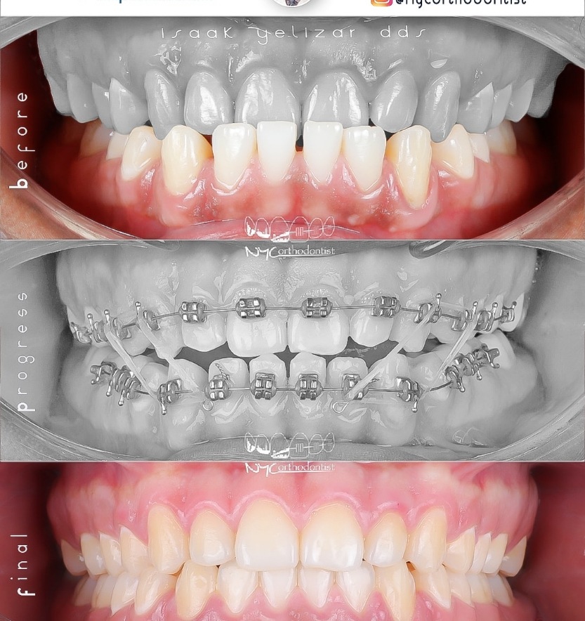 Patient's smiel before during and after underbite treatment
