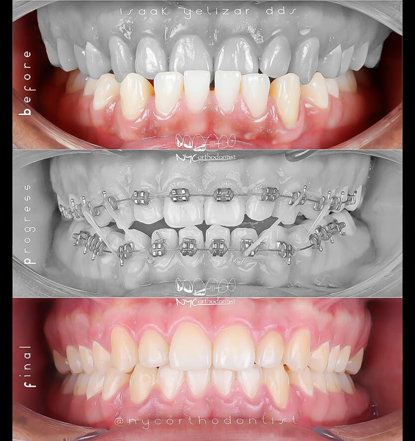 Patient's smiel before during and after underbite treatment