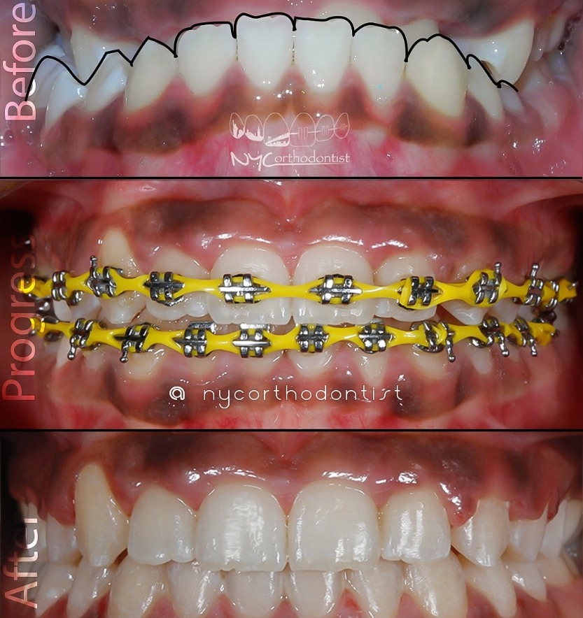 Closeup of smile before during and after underbite treatment