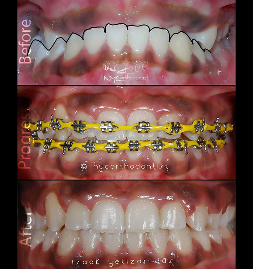Closeup of smile before during and after underbite treatment