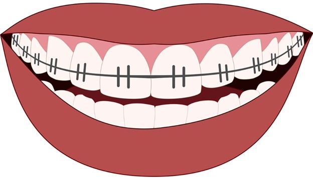 Image of smile with braces.