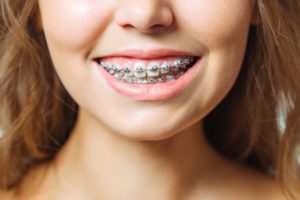 Closeup of girl with braces smiling