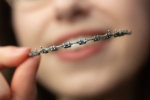 a girl showing her braces that were removed