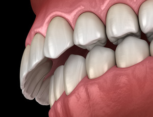 Illustration of what an overbite looks like