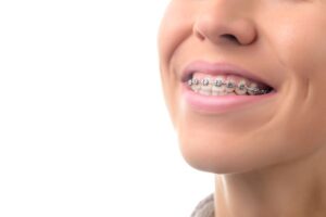 Close-up of woman’s smile with braces