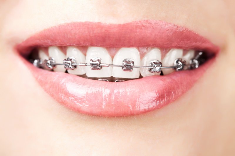 Teeth with braces