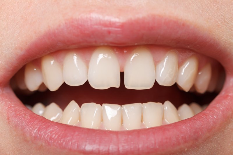 Teeth with gap