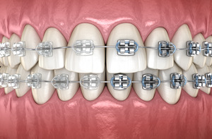 3D render of braces