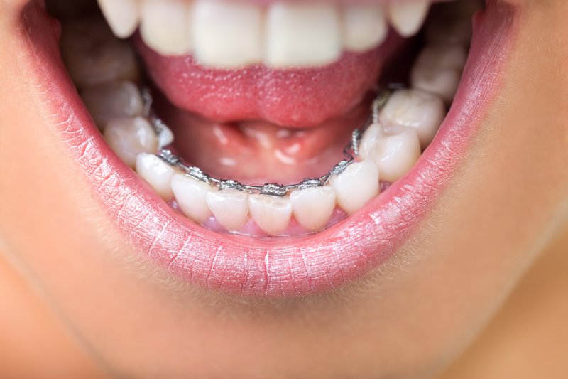 up-close view of lingual braces
