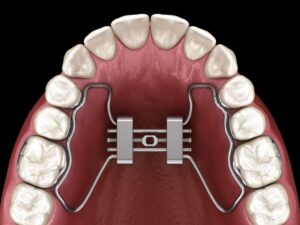 Illustration of palatal expander on patient’s teeth 