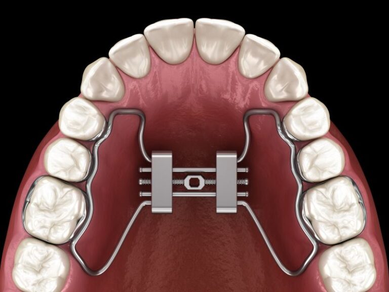 Widening the Upper Jaw: Understanding Different Types of Palatal Expanders