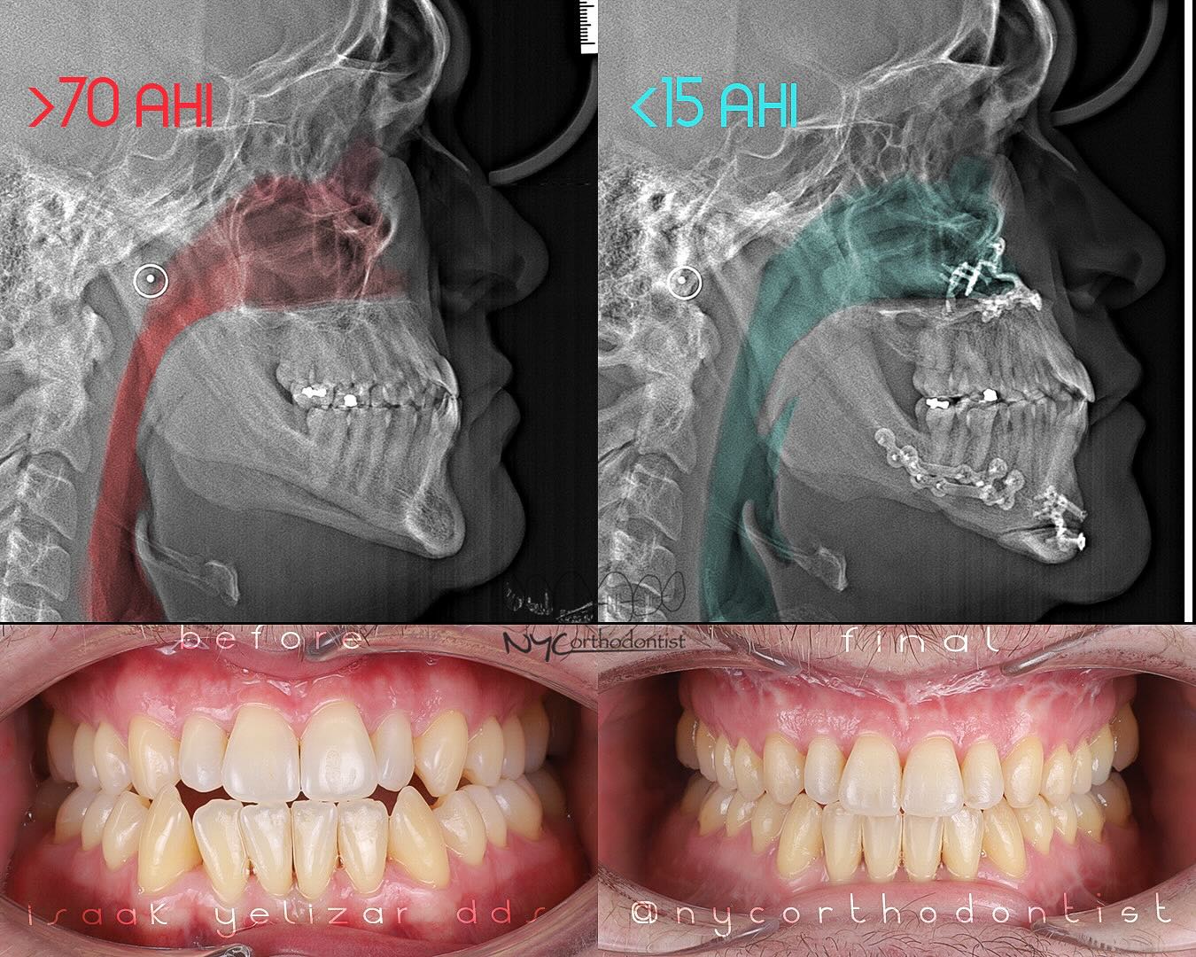 Airway orthodontics consultation in Queens NY